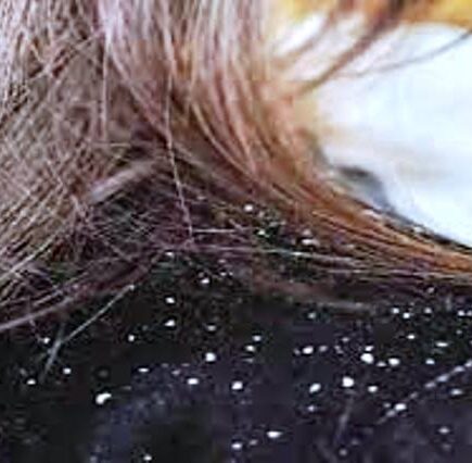 बालों में है डैंड्रफ की समस्या, तो इस तरह पाएं छुटकारा