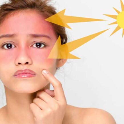 बहुत सी महिलाएं ऐसी होती है जिनका स्किन का कलर काला पड़ जाता है। जिससे सनबर्न की समस्या हो जाती है। ऐसे में लोग सनबर्न से बचने के लिए काफी