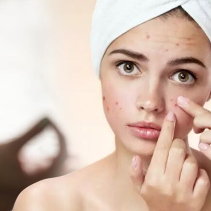 बेसन की मदद से हटाएं चेहरे के पिंपल्स, घर में रखी चीजों का करें इस्तेमाल