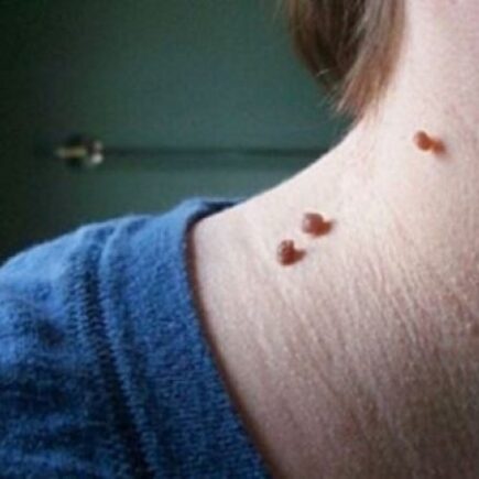 मस्से जैसी समस्या से है परेशान, तो इस घरेलू उपाय करकें पाएं छुटकारा