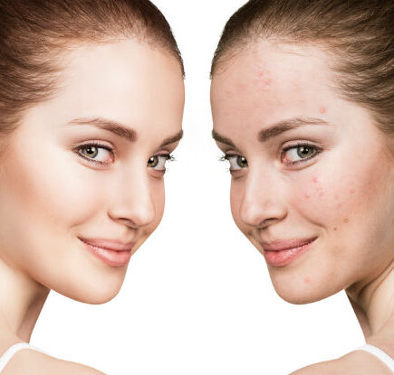 पिंपल्स फ्री त्वचा के लिये जरूरी है ये चीजें, दिखेंगी खूबसूरत, जानियें कैसे