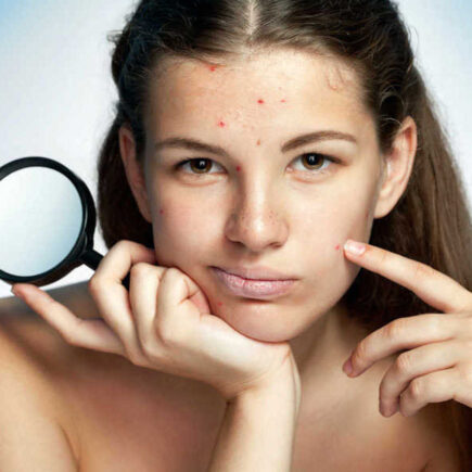 चेहरे पर पिपंल्स जैसी समस्या से है परेशान, तो इस तरह पाएं छुटकारा, जानियें