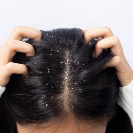 आप भी डैंड्रफ की समस्या से है परेशान, तो इस तरह पाएं छुटकारा, जानिये