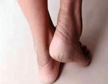 नहीं होगी ऐड़ी फटने की समस्या, बस अपनाएं ये तरीका, पढ़िये