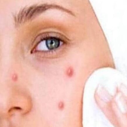 शादी के मौके पर आप भी है पिंपल्स से परेशान, तो ये करे उपाय, जानिये