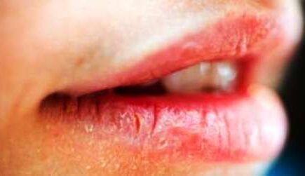 सर्दियों में करें ये उपाय, नहीं फटेंगे होठ, जानिये इसके बारे में