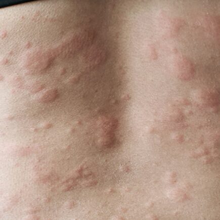 त्वचा में खुजली जैसी है दिक्कत, तो ऐसे पाएं छुटकारा, जानियें