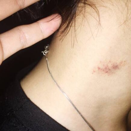 इन ब्यूटी टिप्स से छिपाएं लब बाइट्स, नहीं आएगा नजर