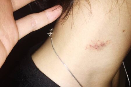 इन ब्यूटी टिप्स से छिपाएं लब बाइट्स, नहीं आएगा नजर