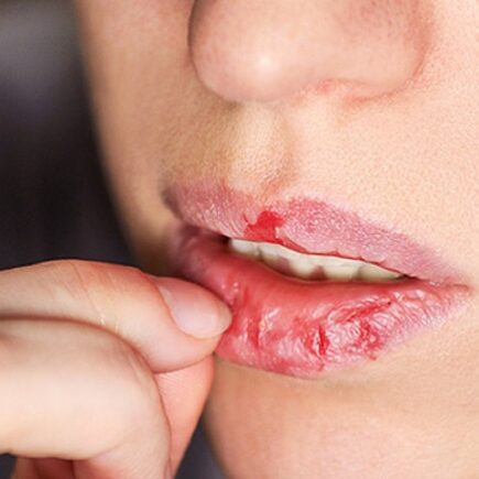 सर्दियों में होंठ फटने जैसी समस्या से है परेशान, ये करें उपाय