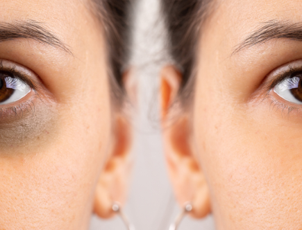 इस तरह दूर करें आंख के नीचे के डार्क सर्कल, जानिये घरेलू उपाय